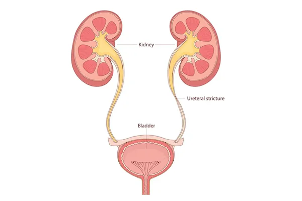 Urethral Stricture