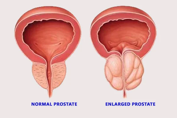 Prostatic Enlargement